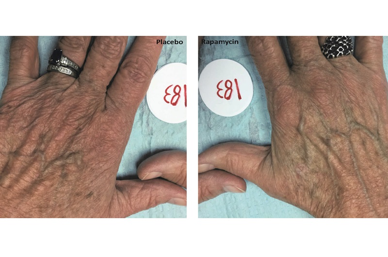 Hand treated with rapymycin alongside placebo untreated hand